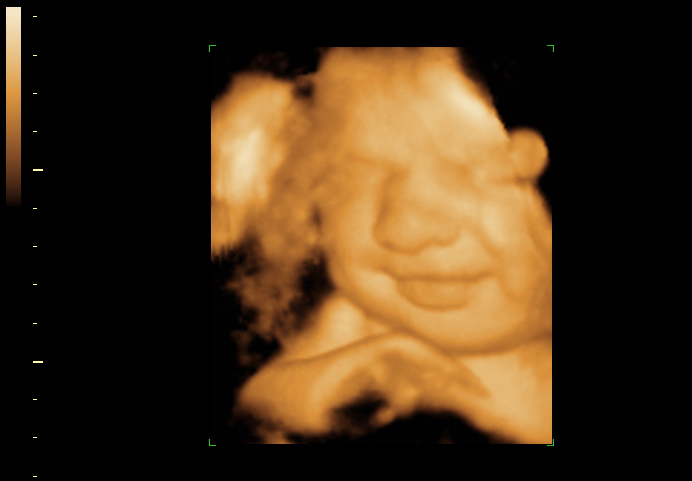 3D ultrasound image at 35 weeks